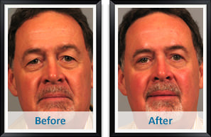 eyelid surgery atlanta